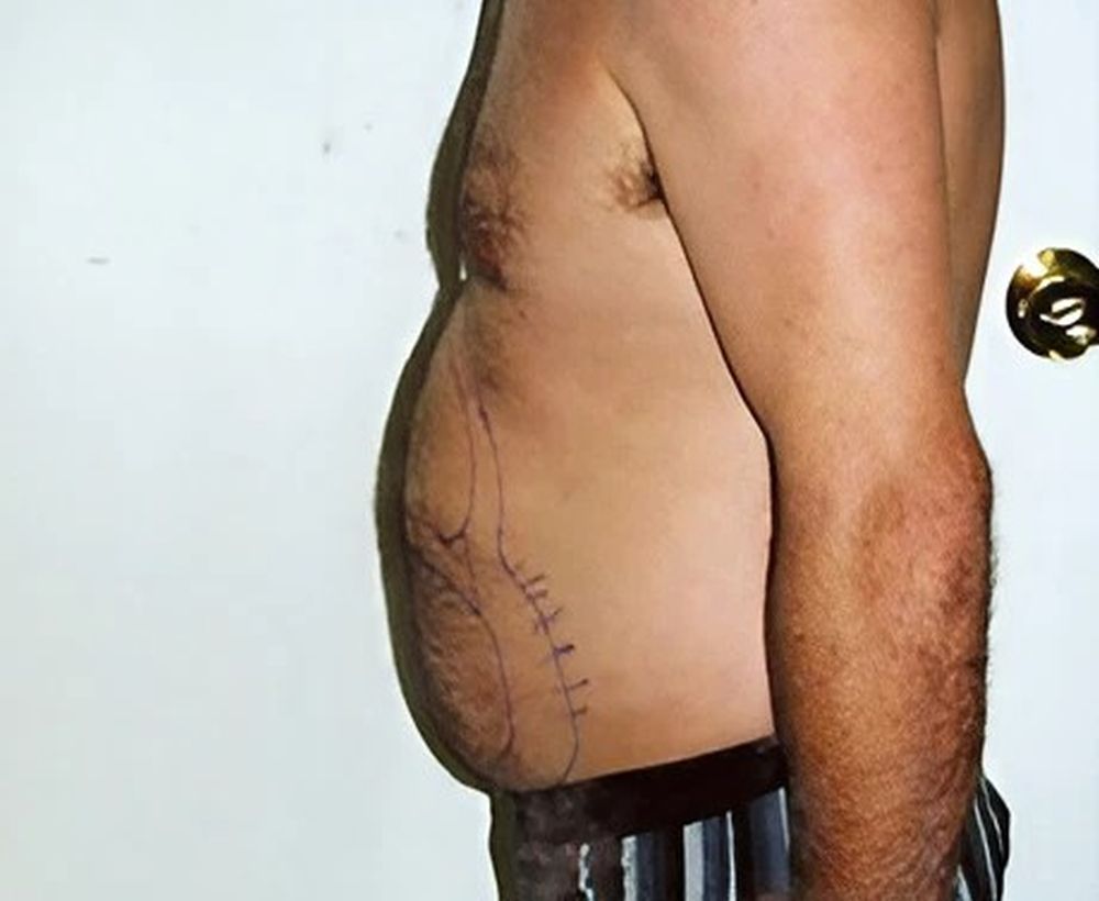 Liposuction and liposculpture procedure - before image