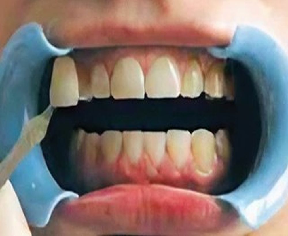 Cosmetic teeth whitening procedure - before image