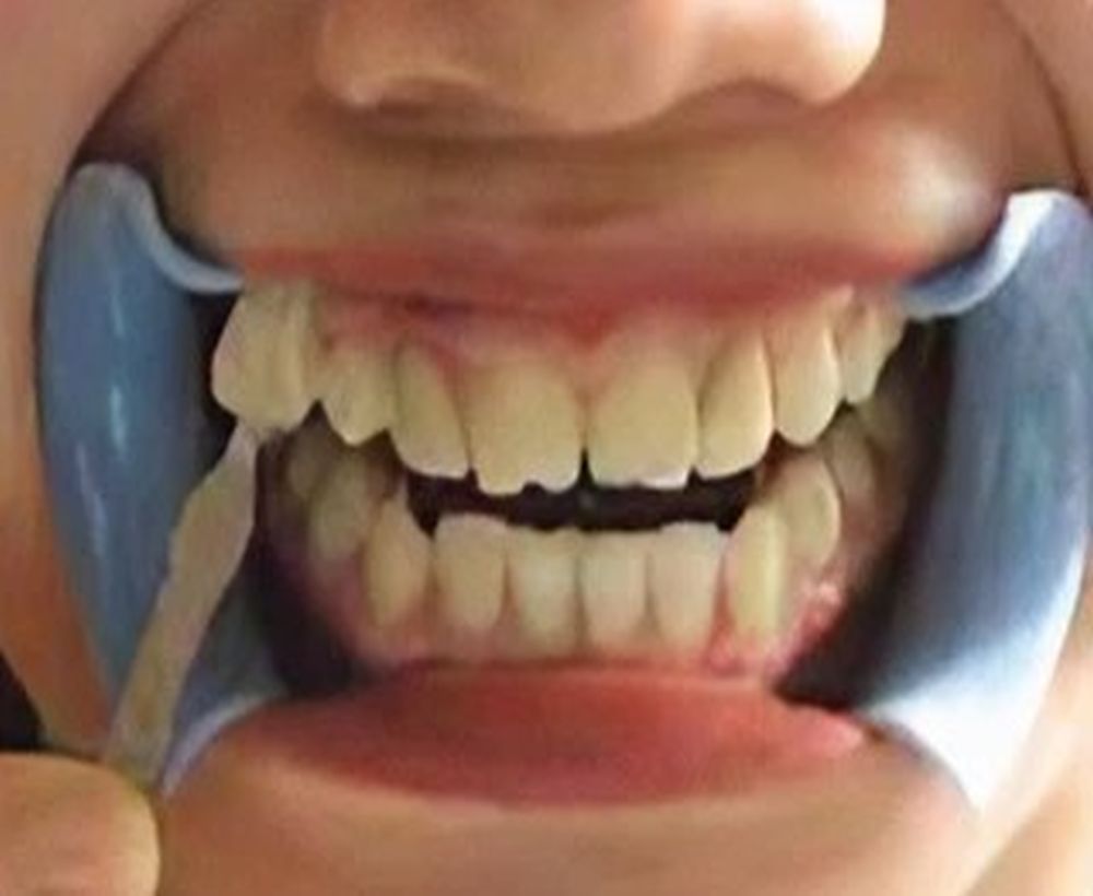 Cosmetic teeth whitening procedure - before image
