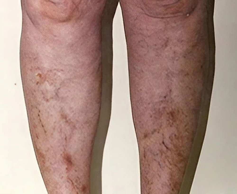 Varicose and spider vein treatments - after image