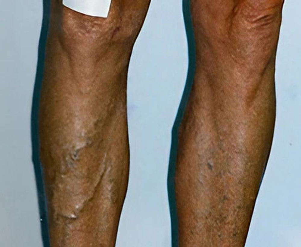Varicose and spider vein treatments - before image