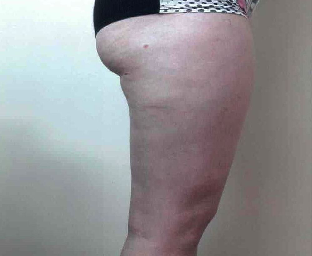 Cellulaze and cellulite removal procedure - after image