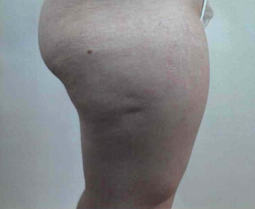 Cellulaze and cellulite removal procedure - before image