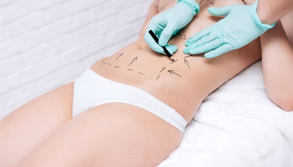 ashbury-cosmetic-liposuction-is-it-for-me-blog