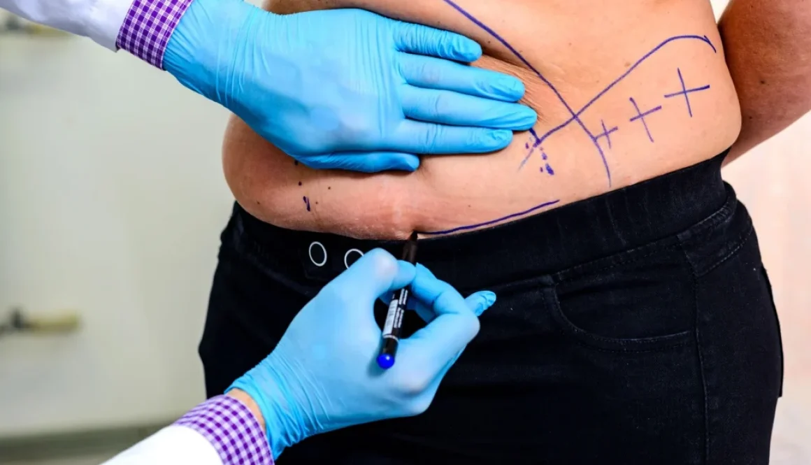 ashbury-cosmetics-laser-liposuction-banner