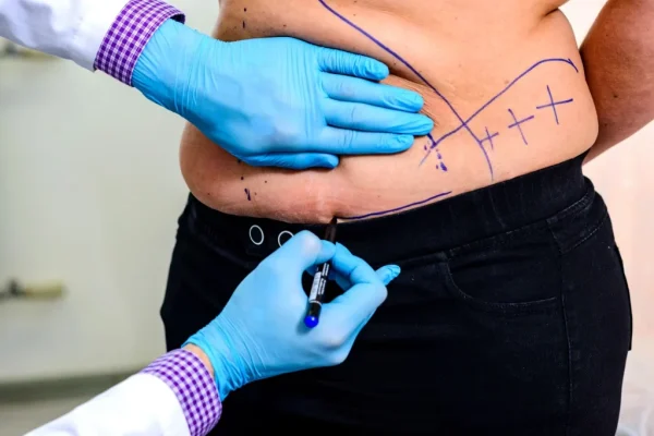 Liposuction