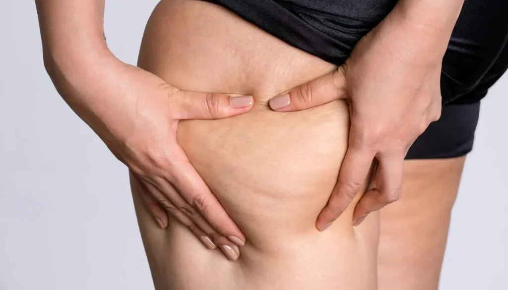 ashbury-cosmetics-cellulite-close-up