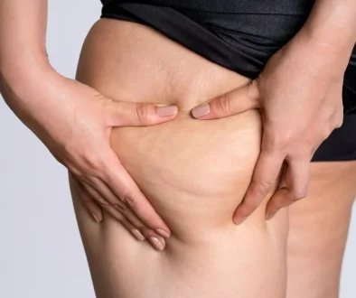 ashbury-cosmetics-cellulite-close-up