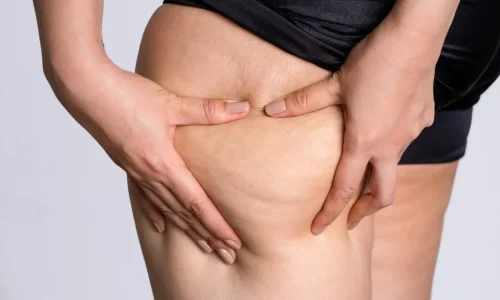 ashbury-cosmetics-cellulite-close-up