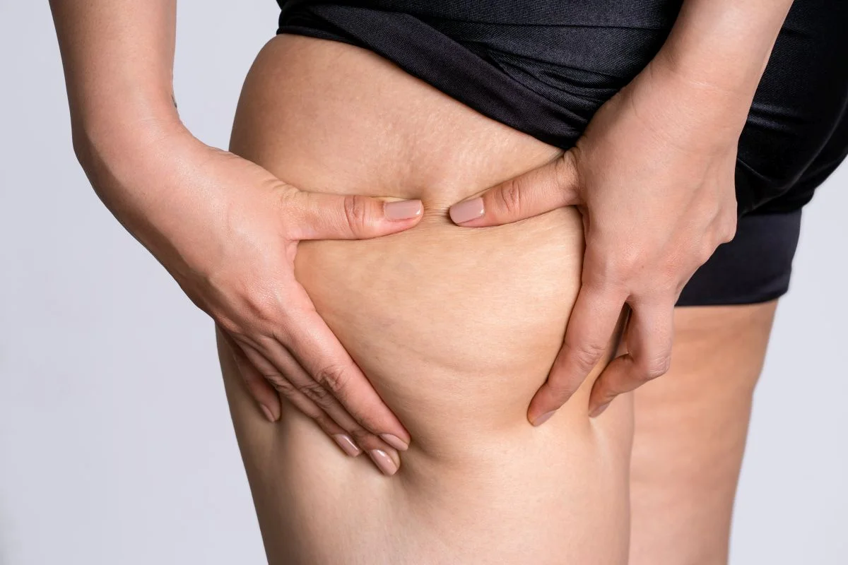 ashbury-cosmetics-cellulite-close-up