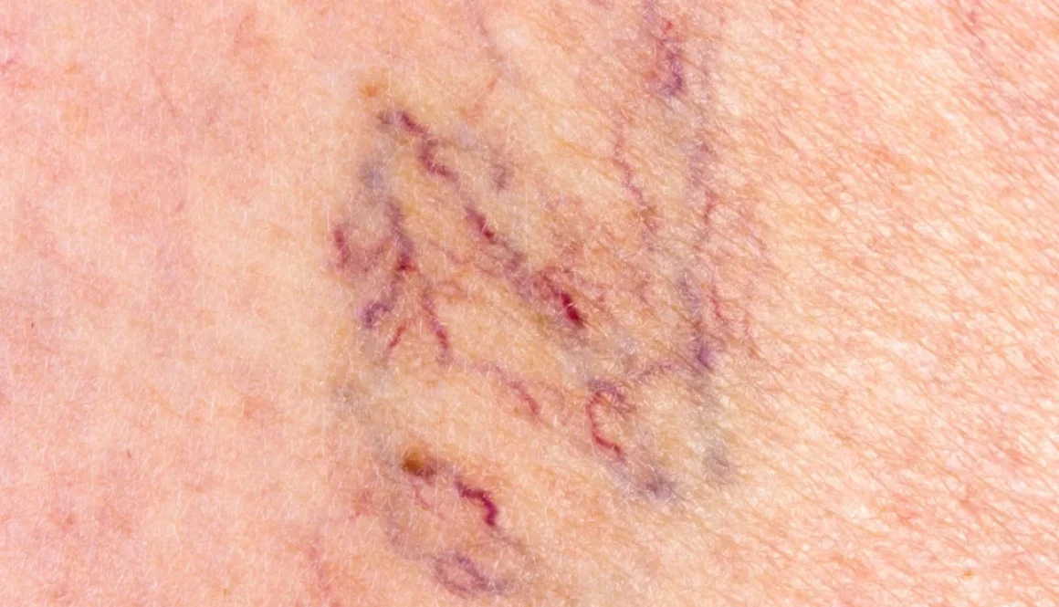 ashbury-cosmetics-varicose-and-spider-veins-banner