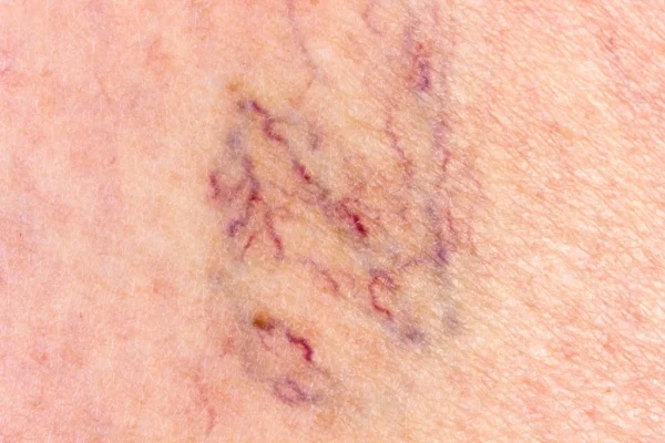 Varicose & Spider Veins
