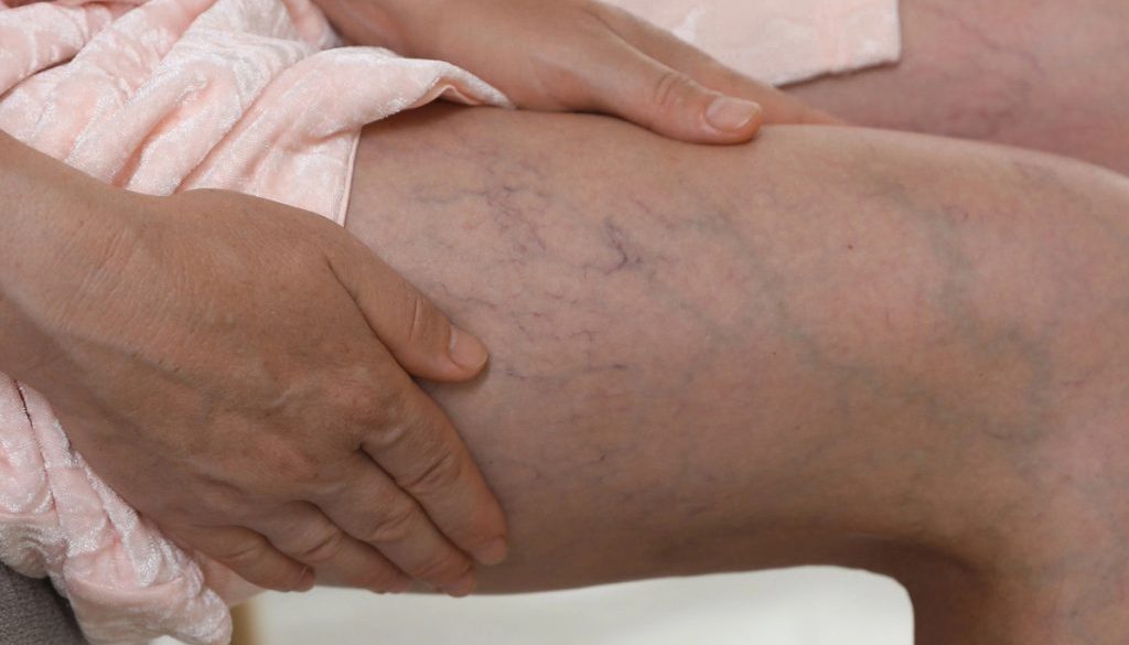 Woman suffering from varicose veins indoors closeup
